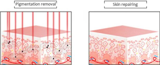 1-10Hz picocare laser tattoo removal machine 2mm 3mm