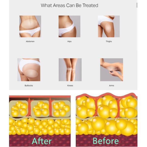 2 In1 Electromagnetic Shockwave Pneumatic Shockwave Air Pressure Therapy Machine