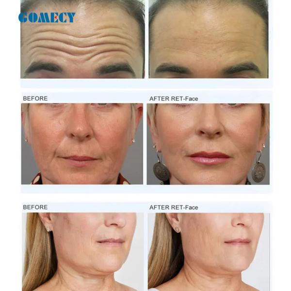 EMS Muscle Stimulator muscle focused for face antiage for Face Neck Lifting Massager Skin Lifting and Firming