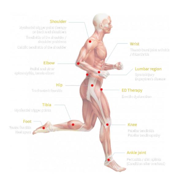 latest company case about Astiland Shockwave Therapy Machine Introduction  8