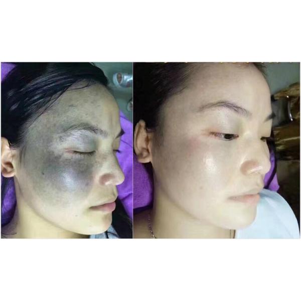 Medical CE Approved HoneyComb lens Picosecond Laser Tattoo Removal Machine Pico Laser