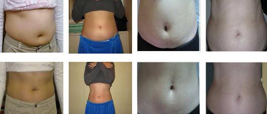 Unparalleled Great Demand 2 professional Cryolipolysis hand pieces body slimming machine