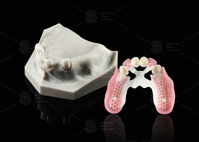 China Biocompatibility Dental Telescope White Inner Zirconia Outer Peek Telescope Dental wholesale