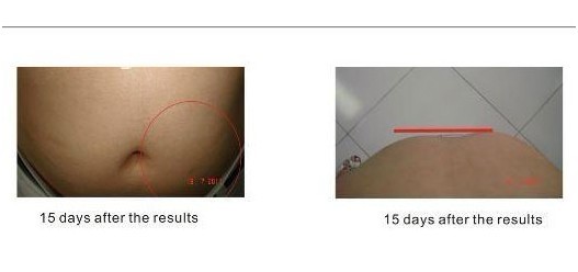 Little Noise Cryolipolysis Machine With Vacuum Pressure 0 - 1Mpa