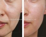 1ml HA Polycaprolactone Sodium Hyaluronate Dermal Filler White