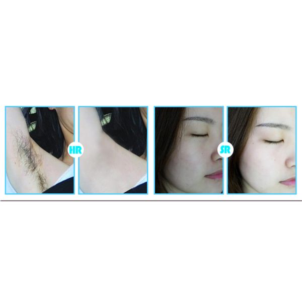 Mini Photorejuvenation IPL Machine Skin Rejuvenation 1.7KG Weight