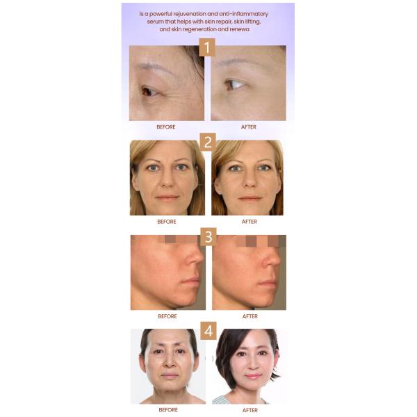 Italy Placentex Skin Booster Injection Pdrn Salmon Whitening Lightening 3ml X 5 Vaila