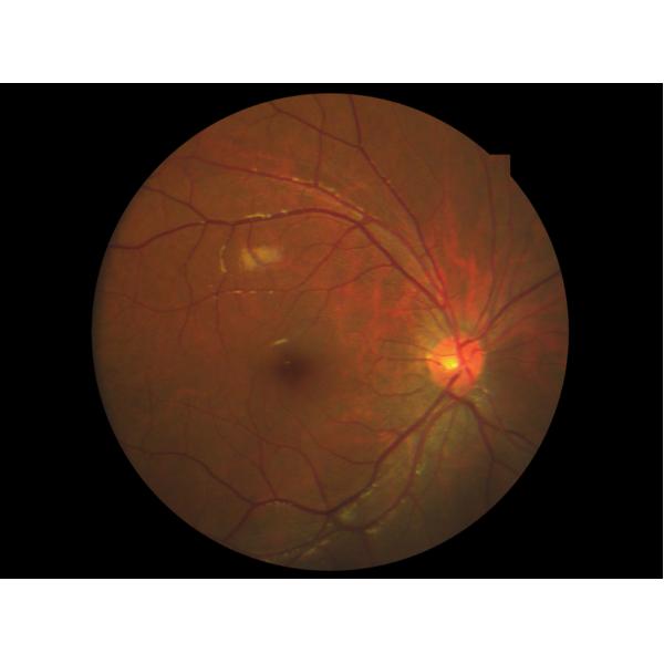 Ophthalmic Non Mydriatic Fundus Camera 50° Field Angle 220V 50 Hz Class I