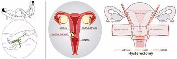 Disposable Gynecological Cervical Brush Medical Female Test Swab