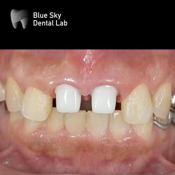 Layered Zirconia Implant Crown Zirconia Abutment Biocompatible