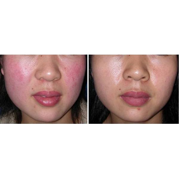 Touch Screen Vascular Rmoval Machine 20W Power Red Blood Removal Machine