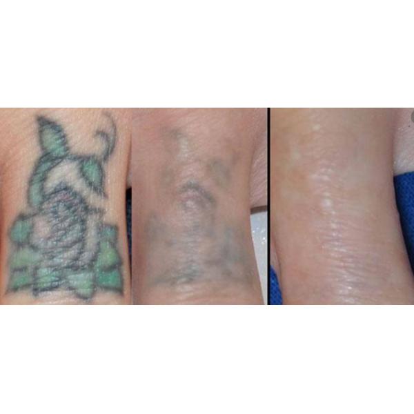 Pico Second Q Switched 1064nm Nd YAG Laser Tattoo Removal Machine Portable