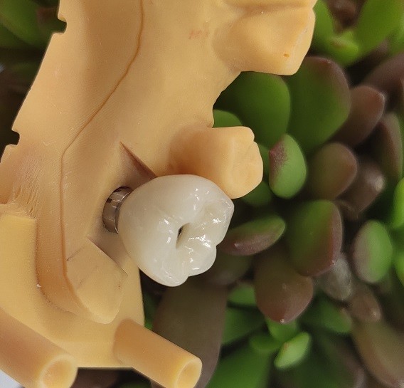 Single Tooth Trushine OSSETEM Dental Implants Fixture Level