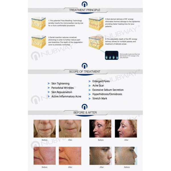 2019 most popular big sell Portable Fractional RF Microneedle Beauty Equipment Device for skin rejuvenation(NBW-FR100)