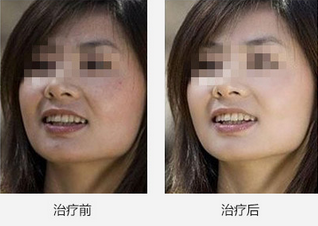 Painfree 808nm Diode Laser Hair Removal Machine , Portable Face Rejuvenation Machine