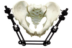 Pelvic Fracture Orthopedic External Fixator Implant Materials For Trauma Operation