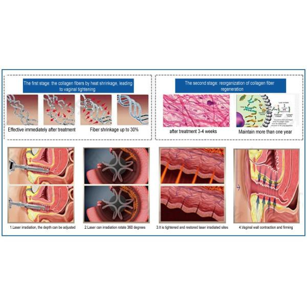 Rejuvenation 10600nm Co2 Laser Beauty Equipment , Co2 Laser Vaginal Machine