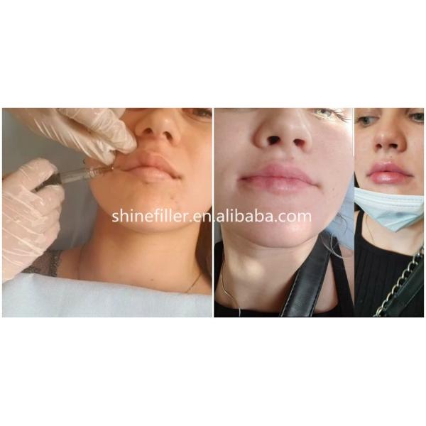 Remove Wrinkle Hyaluronic Acid Gel Injection , HA Dermal Filler Anti Aging