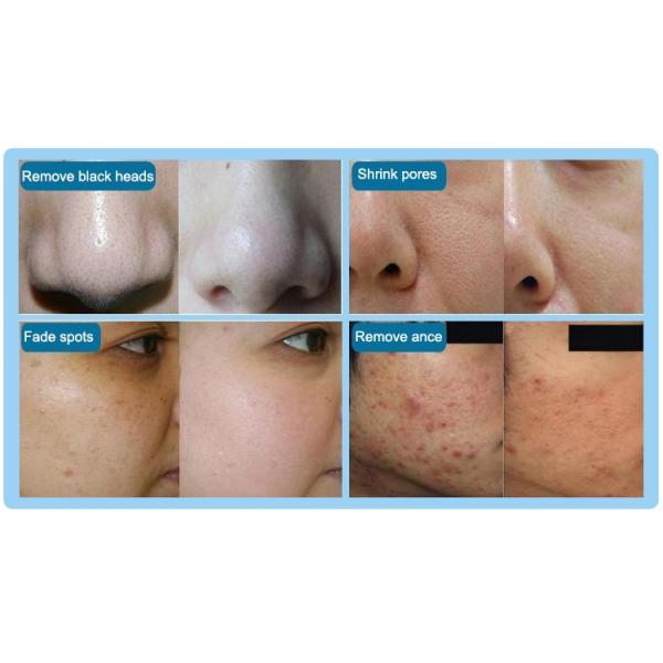 4 Tips Dermabrasion Diamond Peel Hydro Facial Machines