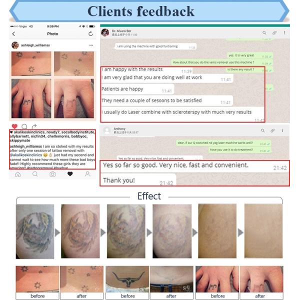 Medical CE Approved HoneyComb lens Picosecond Laser Tattoo Removal Machine Pico Laser