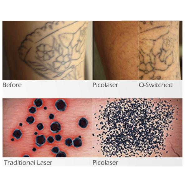 Medical CE Approved HoneyComb lens Picosecond Laser Tattoo Removal Machine Pico Laser