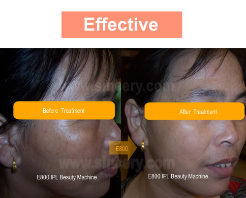 Underarm IPL Laser Hair Removal Machine , Men Female Facial Hair Removal Equipment