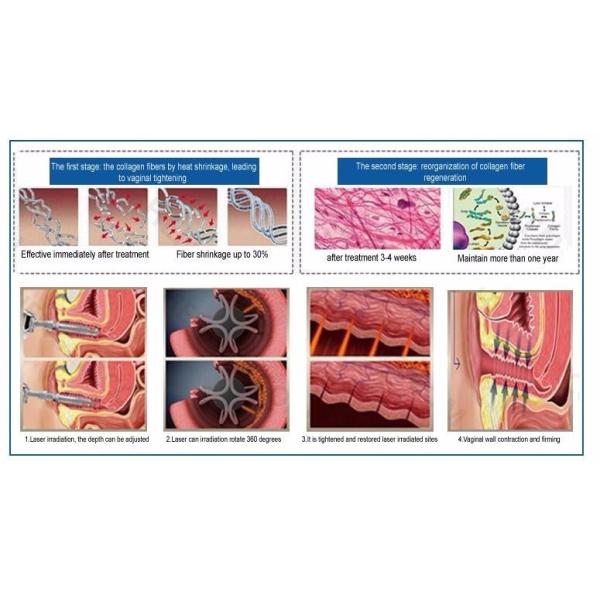 10.64um Air Cooling Co2 Fractional Laser Equipment For Scar Removal