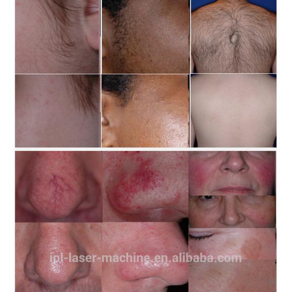 Portable shr-ssr-ipl systems eyebrow hair removal machine shrimp skin remove permanent hair removal for face