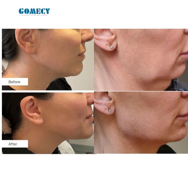 Professional 1470Nm 980Nm Laser Endolifting Machine Smart Light Anti-Aging Facial Slimming