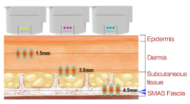 HIFU Ultrasound Beauty Machine For Anti Wrinkle Slimming Face Lifting