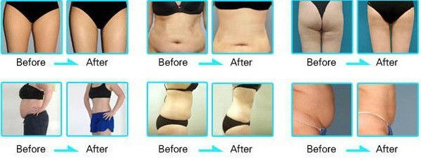 FDA approval high quality hot seller NUBWAY newest vertical cryolipolysis machine