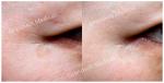 Polycaprolactone Hyaluronic Acid Serum Collagen Rejuvenation PCL Injection