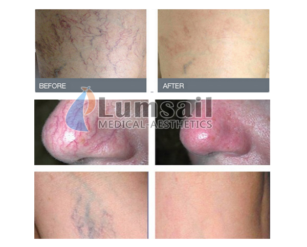 Touch Screen 980nm Vascular Removal Machine For Varicose Veins