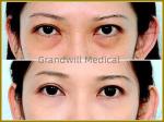 Injectable Sodium Hyaluronate Composite Solution Remove Dark Circles Fill Tear