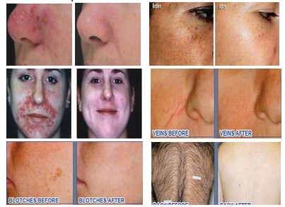 2019 hottest in big sale New High Power IPL Hair Removal Beauty Equipemt Skin Treatment Salon Use