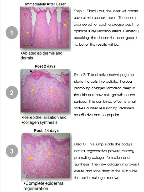 0.1μM Erbium Co2 Fractional Laser Skin Resurfacing Machine with Circulating Water Cooling