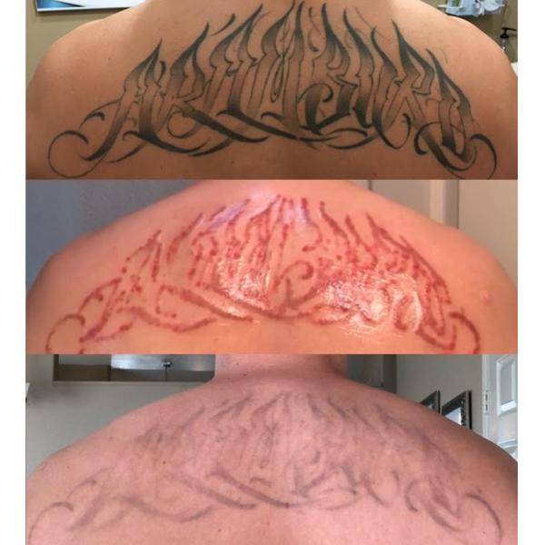 Pico Second Q Switched 1064nm Nd YAG Laser Tattoo Removal Machine Portable