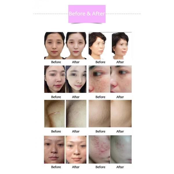 RF Beauty Salon Equipment Gold RF Micro Needle For Wrinkle Removal Skin Tightening 2