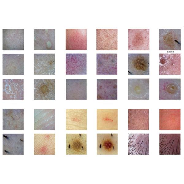 USB Facial Smart Skin Scope Analysis Digital Skin Camera Analyzer With Testing Software