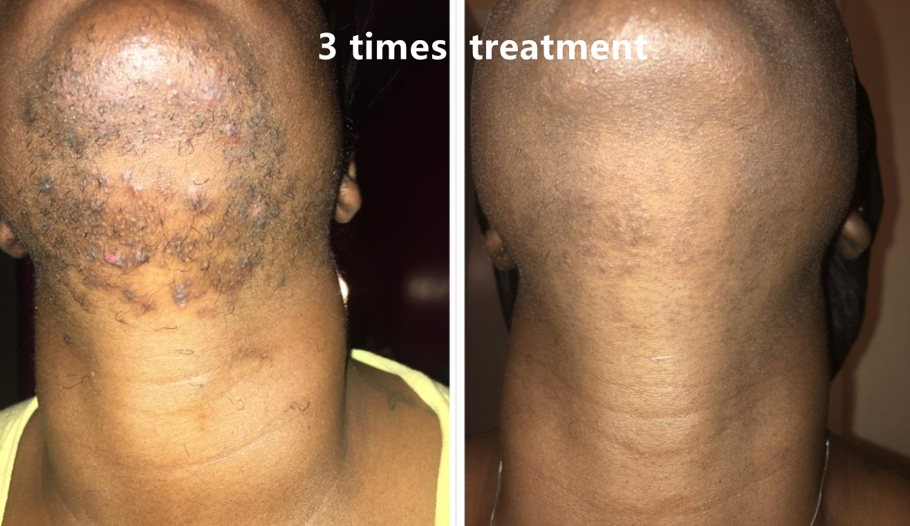 755 808 1064 Diode Laser Skin Hair Removal Device With 6-16 Laser Bars And Touch Screen