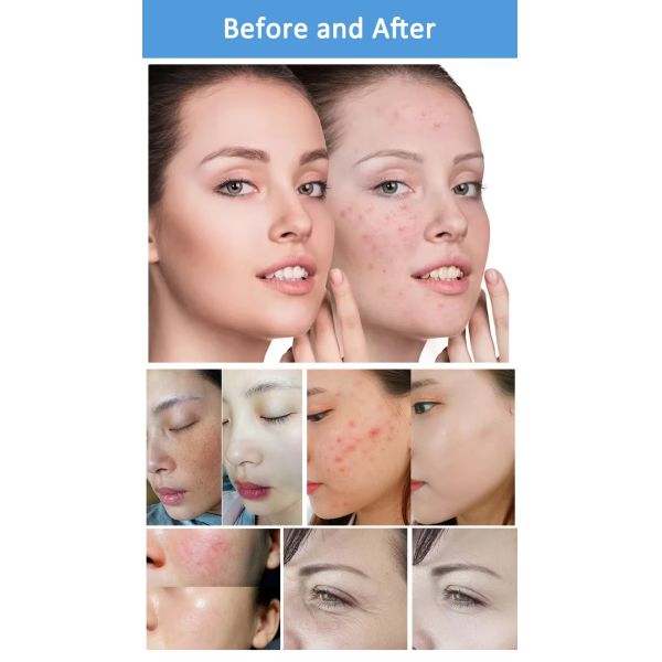 2in1 Gold Microneedle RF Lifting Machine Anti Aging Fractional Machine