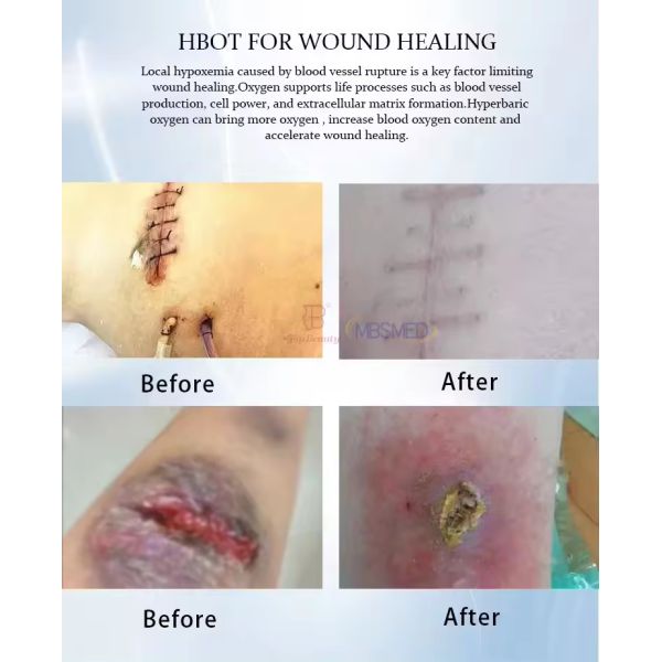 Comfortable Design 2.0ATA Hard Type All-In-One Economical Therapeutic Hyperbaric Oxygen Chamber