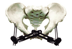 Pelvic Fracture Orthopedic External Fixator Implant Materials For Trauma Operation