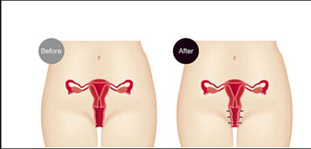 RF Pigment Removal Fractional Co2 Laser Equipment Vaginal Tightening