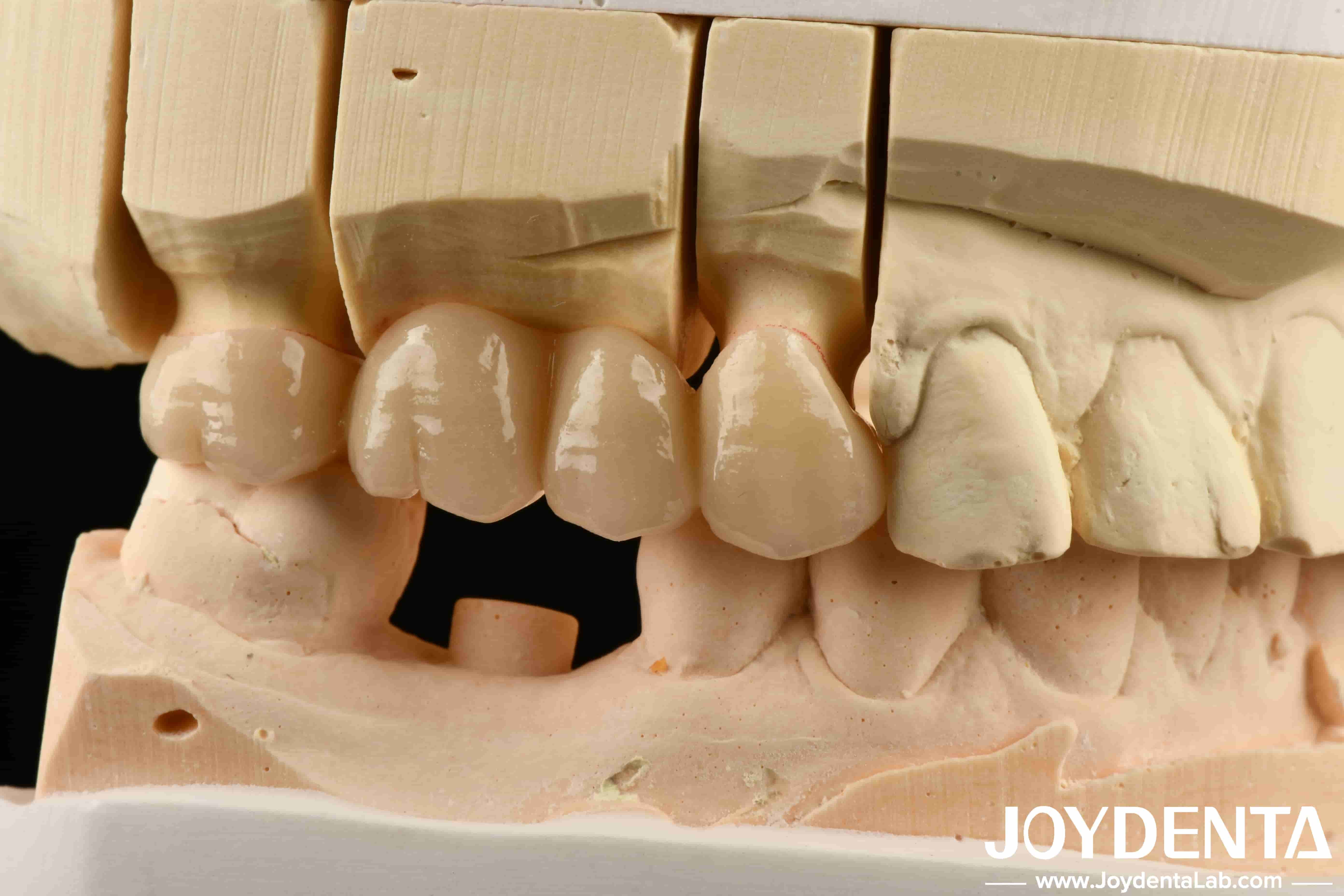 Multilayer Full Zirconia White Style With Layers High Translucency High